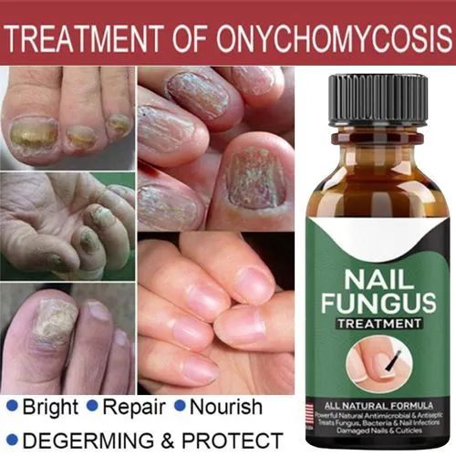fast-nail-fungus-treatment-gel-nail-repair-essence-serum-for-healthy-smooth-strong-nails